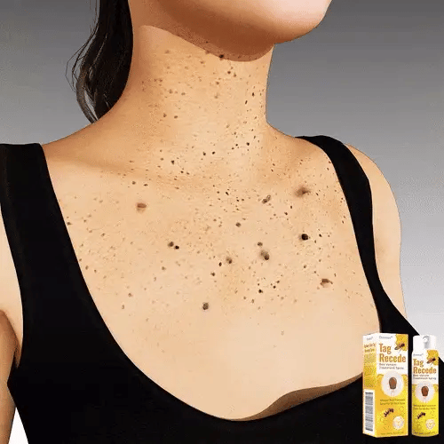 ✨Spray TagRecede Tratamiento Para la Eliminación de Verrugas🌿